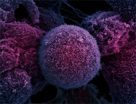 Клітина ракової пухлини простати